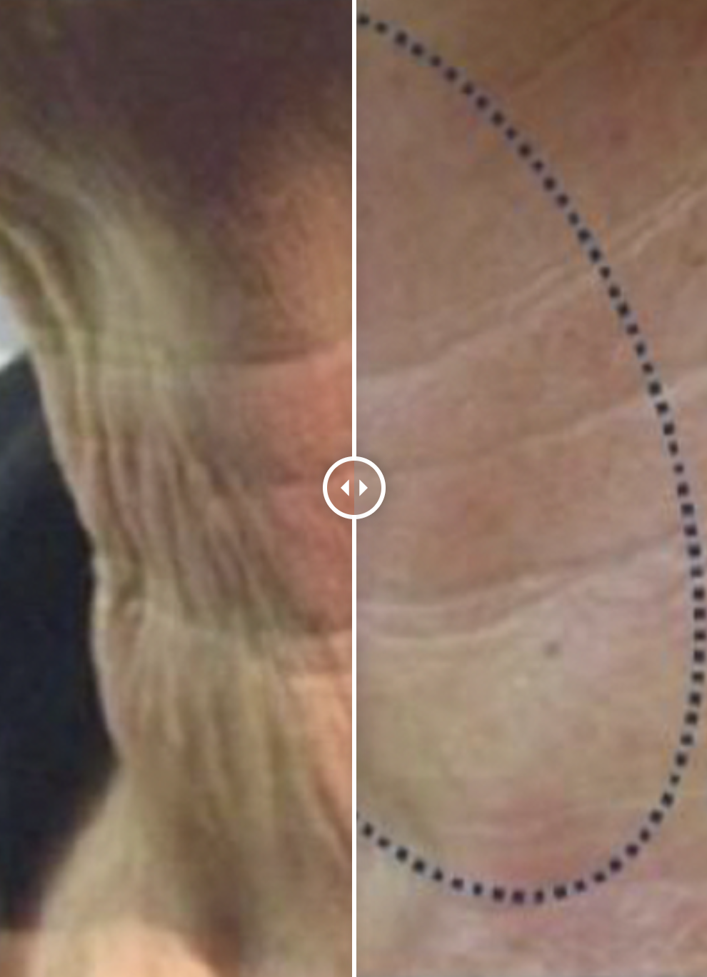 Microneedling before and after acne scar and texture results in Lincoln, NE