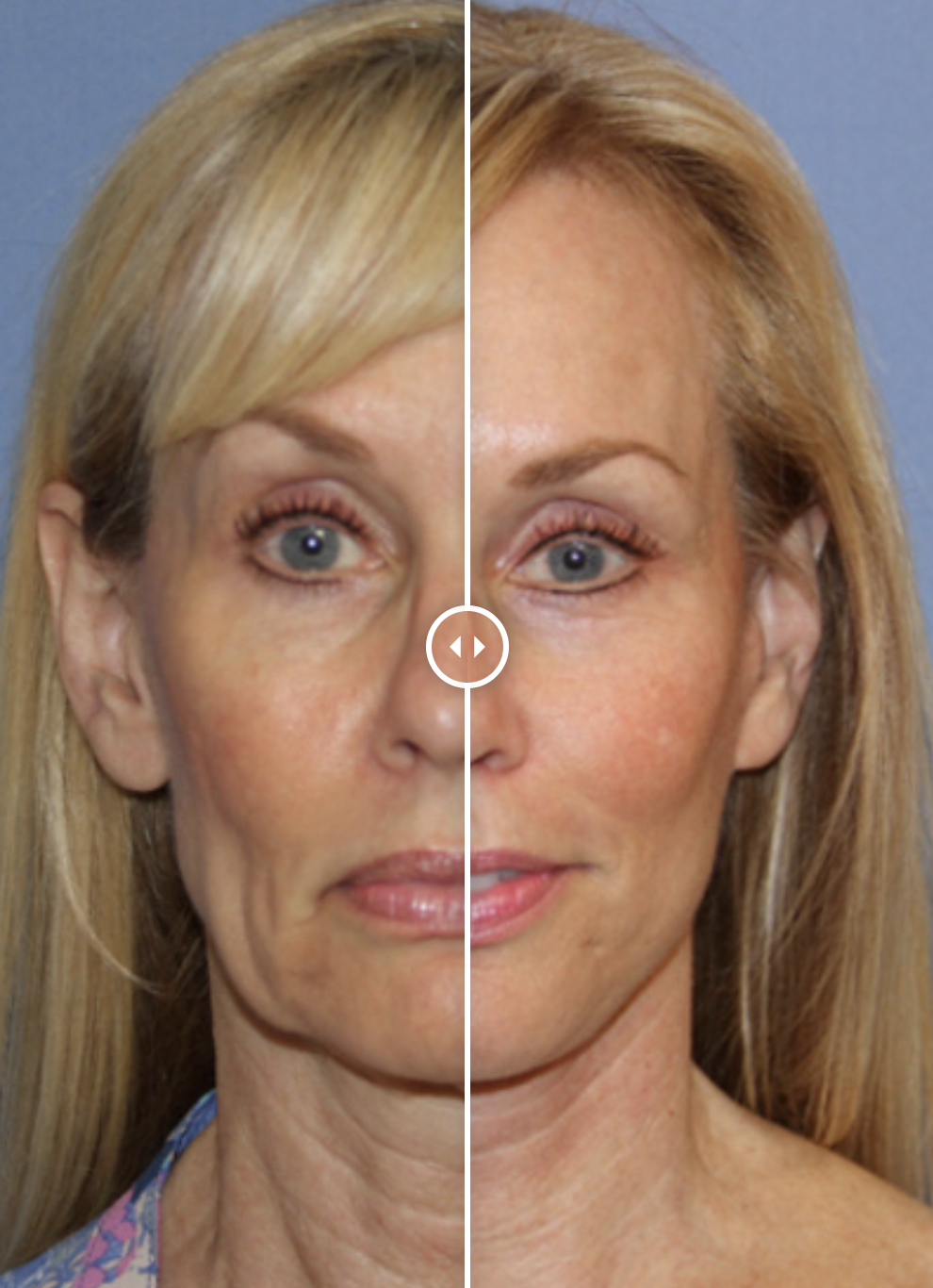 Microneedling before and after results at CRM Aesthetics in Lincoln, NE