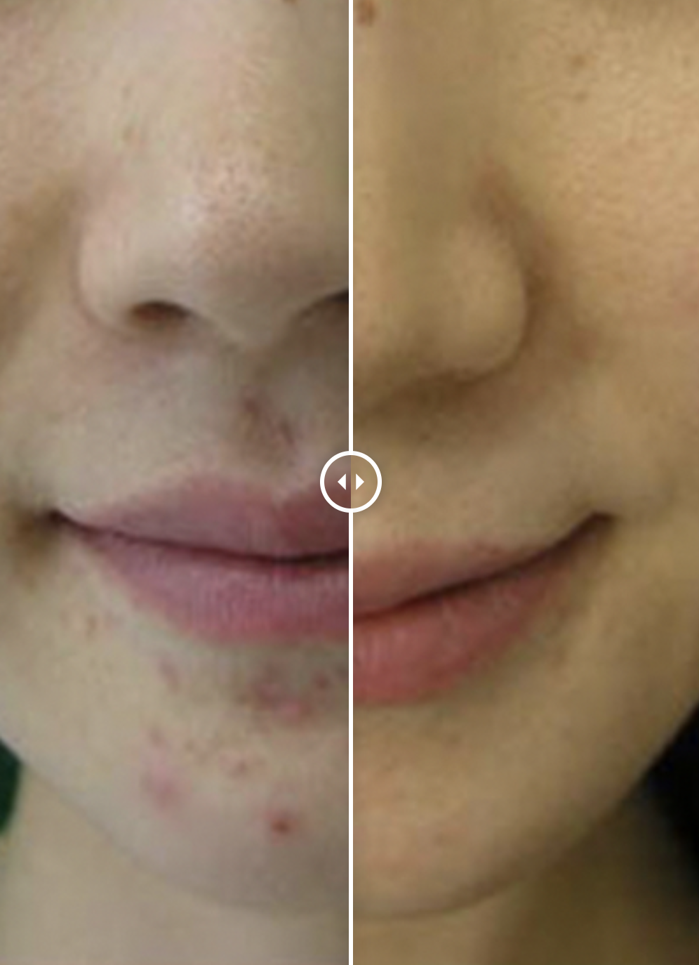 RF microneedling before and after skin results in Lincoln, NE